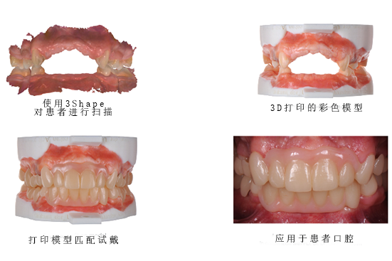 3D打印牙膜.png